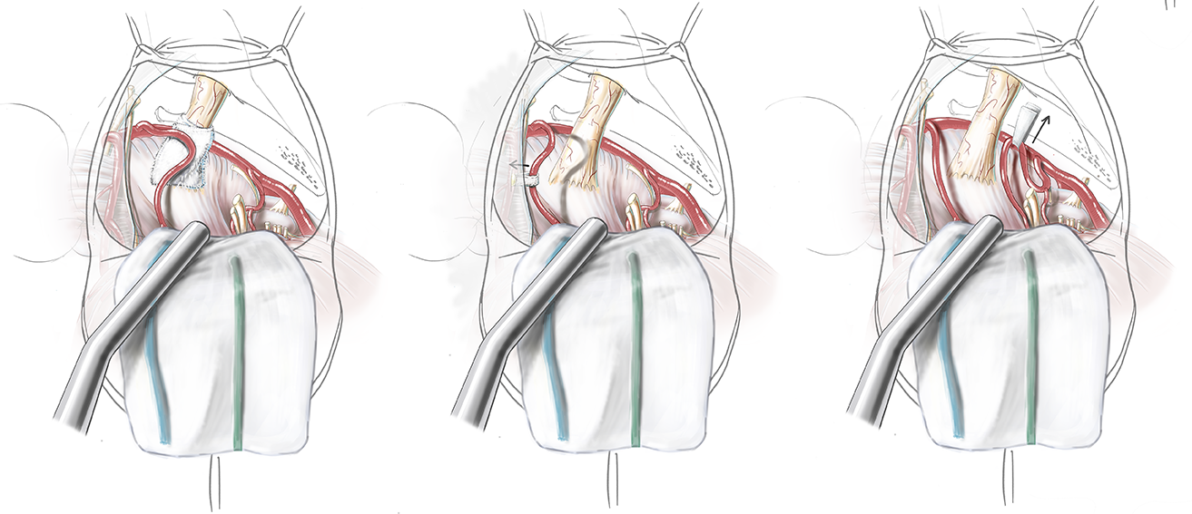 Trigeminal neuralgia